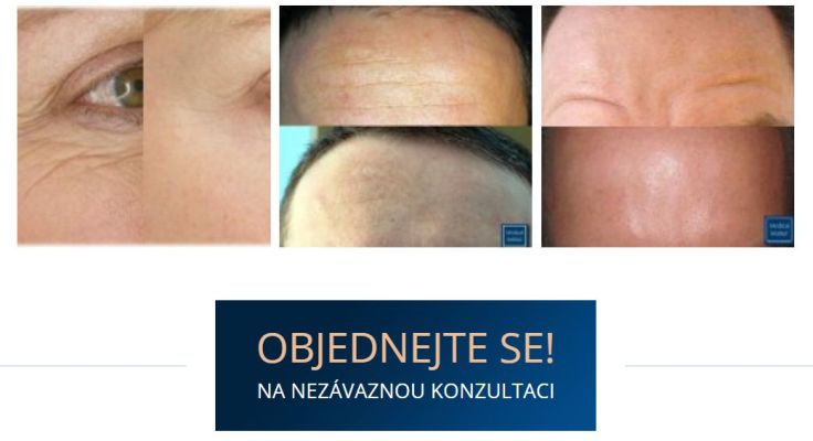 Botox - botulotoxin v Plzni