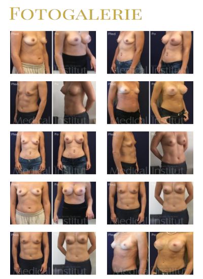 Zvětšení prsou implantáty - co nabízíme v oblasti úpravy prsou